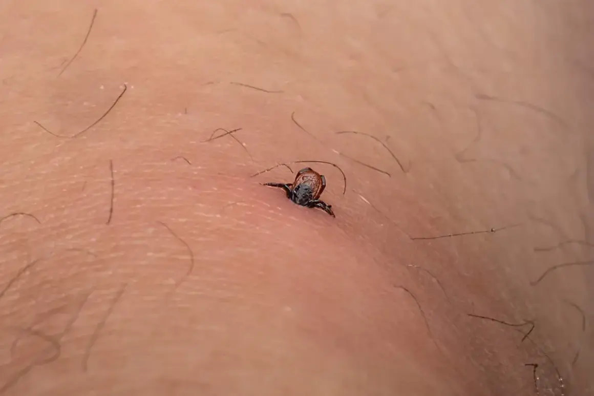 Kleszcz wczepił się w skórę. Zastanawiasz się, czy kleszcz sam odpadnie? Nie czekaj, usuń go jak najszybciej!